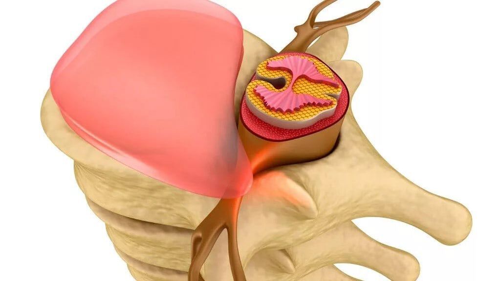 diminution de la puissance due au cancer